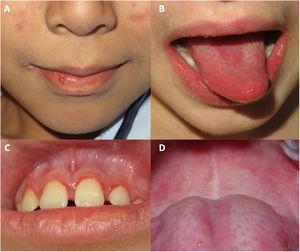 Lesiones en la mucosa oral en pacientes diagnosticados de dermatomiositis juvenil en nuestro hospital durante la pandemia de COVID. A) queilitis; B) lengua depapilada asociada a queilitis; C) eritema y edema en las encías; D) máculas eritematosas y telangiectasias en el paladar.