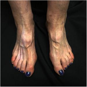 Mancha hipopigmentada, atrofia cutánea y atrofia muscular localizada en el dorso del pie derecho.