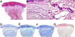 Histological images showing hyperkeratosis and irregular hyperplasia of the epidermis and blood vessel proliferation in a band-like pattern in the superficial dermis. A–C, Hematoxylin eosin, panoramic view (A), original magnification ×20 (B), original magnification ×40 (c). D, CD31. E, Small muscle actin. F, D2-40. G, Perls blue.