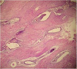 Endometriosis umbilical. Obsérvense los focos de glándulas endometrioides y estroma en el tejido subcutáneo en una mujer de 32 años (hematoxilina-eosina, ampliación original ×100).