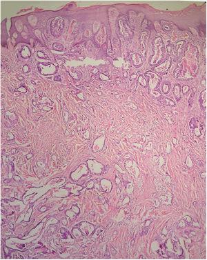 Metástasis umbilical de cistoadenocarcinoma papilar seroso originado en el ovario de una mujer de 40 años (hematoxilina-eosina, ampliación original ×60).