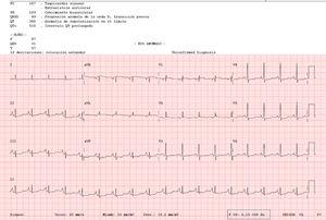 Electrocardiogram (ECG) showing a prolonged QT interval (QTc, 510ms), nonsignificant ST segment depression, and increased P wave axis.