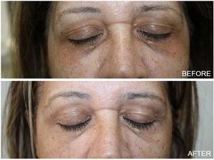 Patient with DC before treatment with 10% phenol and 20% TCA combination peel and on follow up visit one month later.