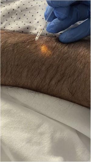 Fibra de láser de Alejandrita con emisión de luz lateral. Pruebas previas en el paciente.