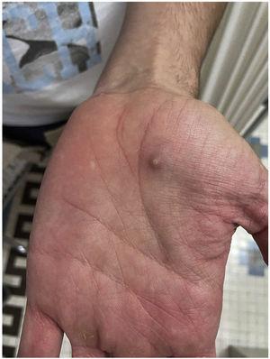 Lesión pustulosa umbilicada en palma de mano izquierda.