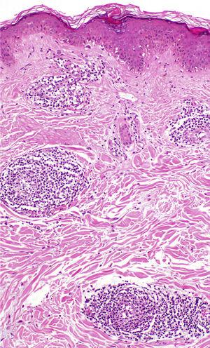Histopathologic image. Discrete, predominantly lymphocytic, perivascular inflammatory infiltrate (hematoxylin-eosin, original magnification ×100).