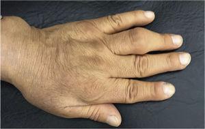 Slightly indurated erythematous–edematous plaque with diffuse borders affecting the anatomical snuff box and metacarpal region of the second and third finger on the dorsum of the left hand.