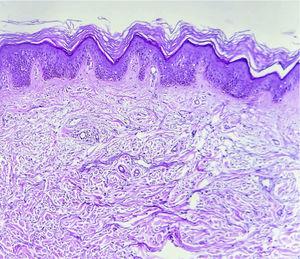 Hyperkeratosis and mild acanthosis–papillomatosis. Mucin deposits between collagen bundles in the dermis (hematoxylin–eosin, ×100).