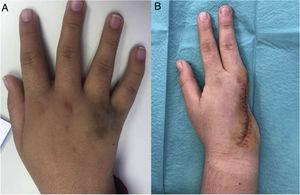 Right hand of the patient. A, Preoperative image, showing a brownish, slightly raised plaque at the level of the fourth commissure. B, Postoperative appearance.
