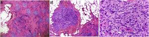 Histological image of a plexiform fibrohistiocytic tumor. A, Hematoxylin–eosin (H–E), original magnification ×4. B, H–E, original magnification ×10. C, H–E, original magnification ×200.