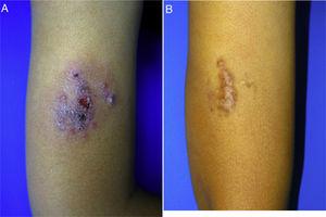 Childhood cutaneous leishmaniasis. A, Very painful crusted, exudative, erythematous violaceous plaque (8×6cm) on the arm of a 10-year-old boy. B, Lesion control achieved 6 months after treatment with oral miltefosine. Residual brownish plaque on the arm. The patient remained asymptomatic.