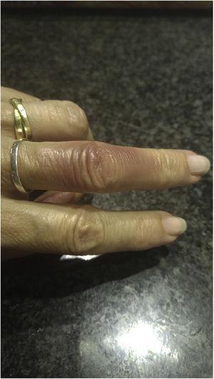 Hematoma on the dorsal aspect of the finger.