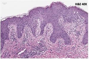 Histological findings on skin biopsy: patchy spongiosis with focal lichenoid reaction, mild papillary dermal edema and red cell extravasation and a perivascular lymphocytic infiltrate; very rare apoptotic keratinocytes can also be seen.