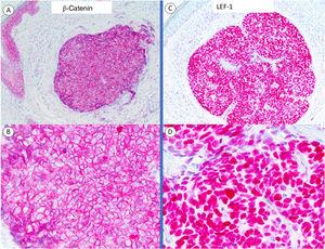 Immunohistochemical staining with β-catenin and LEF-1. A and B, Panoramic view and close-up of β-catenin staining showing membranous staining, similar to that seen in epidermal keratinocytes, which serve as a positive control. C and D, Panoramic view and close-up with LEF-1 showing nuclear positivity in all the cells forming the tumor.