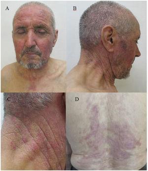 (A and B) Violaceous erythema in areas of the face and neck exposed to sunlight. (C) Detail of the lateral surface of the neck with somewhat more infiltrated papular areas. (D) Violaceous erythema in previously affected areas on the back.