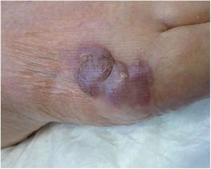 Imagen clínica: lesión excrecente de aspecto violáceo localizada en el dorso del pie izquierdo.