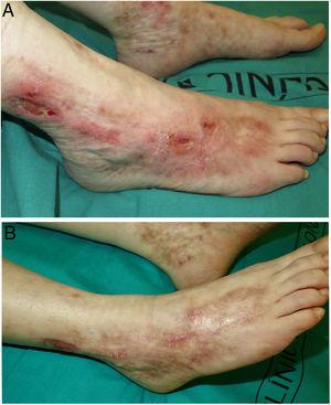Vasculopatía livedoide (paciente 1). A. Úlceras y erosiones, eritema y cicatrices atróficas en los tobillos y pies. B. Respuesta completa tras 3 meses de tratamiento con rivaroxabán.