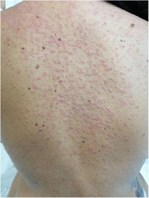 Clinical image: confluent erythematous papulosquamous lesions on the back.