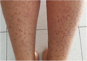Clinical image: erythematous papules with silvery scaling on the lower limbs.