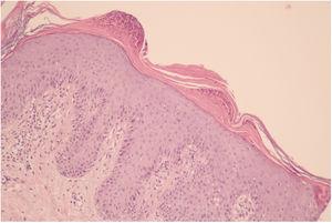 Histological image (hematoxylin–eosin) showing an irregular acanthotic epidermis and hyperkeratosis with parakeratosis. Munro microabscesses are observed in the stratum corneum.