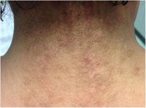 Poikiloderma-like lesions, with areas of atrophic skin on the posterior aspect of the neck.