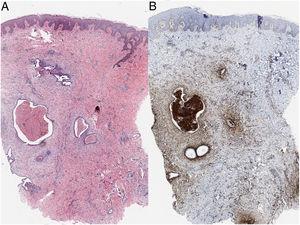 A, Endometrial glands in the dermis (hematoxylin–eosin, original magnification ×4). B, Positive staining with CD10 in the endometrial interstitium (original magnification ×4).