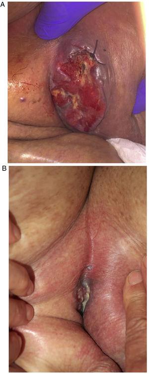 A, Ulcerated left inguinal mass measuring 8cm×9cm fixed to the deep planes. B, Significant reduction in size after 8 weeks of dual HER2 blockade.