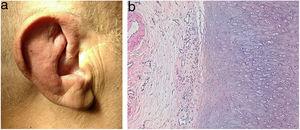 a) Eritema y edema de los pabellones auriculares. b) Biopsia de pabellón auricular, mostrando cartílago degenerado e inflamación crónica en pericondrio. Hematoxilina-eosina, ×100.