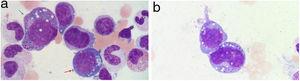 a) Vacuolización de núcleo y citoplasma de precursores mieloides (flecha azul) y eritroides (flecha roja) en aspirado medular. May-Grunwald-Giemsa, ×100. b) Vacuolización de núcleo y citoplasma de precursores mieloides medulares. MayGrunwald-Giemsa, ×100.