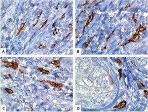 Immunohistochemical localization of the telocytes in the human normal skin using CD117 (C-KIT). (A–D) spindle-shaped telocytes (TCs) are stained by CD117and the brown chromogendiaminobenzidine. The TCs can be easily separated from the surrounding other stromal cells. The TCs have an elongated appearance with oval or triangular nuclei (counterstained with Mayer's hematoxylin) and long, varicose tadpole-like processes extending from their cell bodies (original magnification, ×1000, oil immersion).