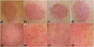 Allergic reactions (++/+++). Upper row (1), clinical images; lower row (2), dermoscopic images. All the dermoscopic images reveal homogeneous and diffuse erythema, especially in a2, but also in (b2), “soap bubble” vesicles (black arrowheads), (c2) dotted vessels, occasional crusts, and yellow-orange areas, and (d2) nonfollicular pustules (green arrowheads).