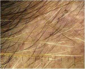 Pigtail (circle) hairs.