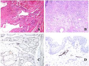 A) Malformación arteriovenosa (hematoxilina-eosina ×40). B) Foco de pequeños vasos proliferativos vasculares en una malformación vascular arteriovenosa (hematoxilina-eosina ×40). C) Malformación venosa inmunoteñida con CD31. Los endotelios positivos destacan la morfología anormal de los vasos dilatados (CD31 ×40). D) Inmunotinción para D2-40 que muestra un endotelio positivo en los linfáticos de la dermis papilar (D2-40 ×200).