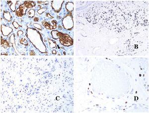 A) Hemangioma infantil positivo para GLUT-1. Los endotelios positivos se evidencian claramente. La positividad de los glóbulos rojos es útil como control (GLUT-1 ×400). B) Inmunoexpresión de WT1 en un área de pequeños vasos sanguíneos proliferativos evidenciada en una malformación arteriovenosa (hematoxilina-eosina ×40). C) Las áreas proliferativas que se observan principalmente en las malformaciones arteriovenosas son positivas para Ki-67 en un pequeño número de núcleos endoteliales (Ki67 ×200). D) Malformación vascular. Inmunotinción con Ki67. Las células endoteliales son negativas. Se debe de tener cuidado de no leer mal las celdas positivas circundantes (Ki-67 ×400).
