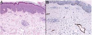Staining with hematoxylin–eosin. (A) Note the dermal edema, interspersed with fibrosis and a scant superficial perivascular lymphoid infiltrate. (B) Staining with podoplanin (D2-40) highlighting lymphangiectasia in the dermis (B).