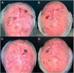 Clinical images of a locally advanced, multifocal squamous cell carcinoma on the scalp. A and B, before immunotherapy. C and D, complete remission after a cycle of pembrolizumab 200mg every 3 weeks. The patient remained in complete remission after just 3 cycles of pembrolizumab and 21 months without treatment.