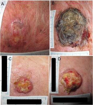 Squamous cell carcinoma on the scalp with a diameter of 27mm at time 1 (T1) (A) and 53mm at T2, 84 days later (B). Squamous cell carcinoma on the scalp with a diameter of 20mm at T1 (C) and 28mm at 133 days (T2) (D).