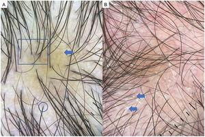 Androgenetic alopecia. A, Heterogeneity of hair thickness and anisotrichosis (square), brown peripilar signs (arrows), and white peripilar signs (circles). B, Note the thick interfollicular scaling (arrow) due to associated seborrheic dermatitis in androgenetic alopecia.
