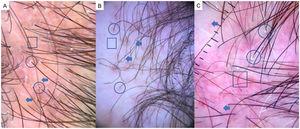 A, Lichen planopilaris. Note the absence of follicular openings (arrows), hyperkeratosis and perifollicular erythema (circles), and white dots (square). B, Frontal fibrosing alopecia. Note the erythema and concentric perifollicular hyperkeratosis (circles), absence of follicular openings (square), and loss of vellus hair plus fragile hair (pili torti) (arrows). C,Frontal fibrosing alopecia in men. Note the erythema and perifollicular hyperkeratosis (circles); anisotrichosis (square); and miniaturization, and vellus hair along with areas of scarring/bald patches (square).