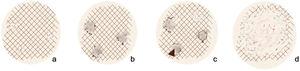 Modified dermoscopic extrafacial lentigo maligna progression model adapted from Gamo-Villegas et al.2 A, Reticular disruption. B, Erased area and triangular structures. C, Angulated and zig-zag lines. D, Large areas.