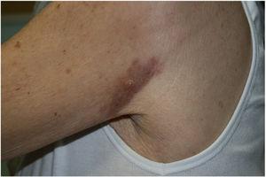 Follow-up visit. Left shoulder: residual erythematous-violaceous macule, with a single vesicle in the center.