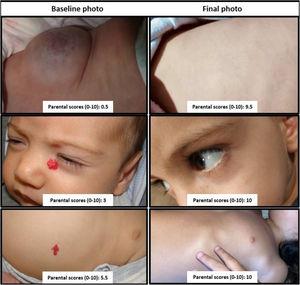 Parental Assessment of Infantile Hemangioma Cosmetic Clinical Outcomes: Results of the Spanish Hemangioma Nationwide Prospective Cohort
