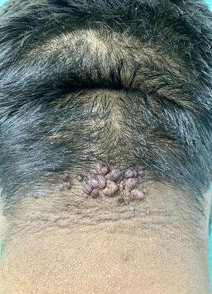 Acné queloideo de la nuca, un reto terapéutico para los dermatólogos