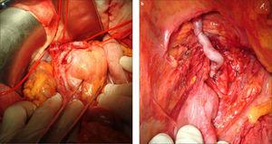 Arteria gastroduodenal elongada junto a los dos aneurismas (a) y reimplantación de la arteria gastroduodenal en la aorta (b).