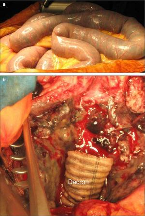 Imágenes operatorias: a) Asas intestinales con sangre en su interior; b) Pared aórtica, dacron seccionado.