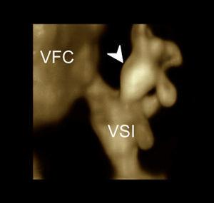 Vena epigástrica superficial dilatada (flecha) llegando al cayado de la vena safena interna. VFC: vena femoral común, VSI: vena safena interna.