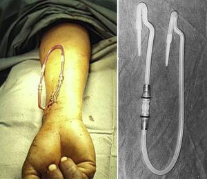 El dispositivo revolucionario conocido como la derivación de Scribner era un tubo en forma de U instalada de forma permanente entre una arteria y una vena del brazo para que la máquina de diálisis pudiera unirse tan a menudo como fuese necesario.