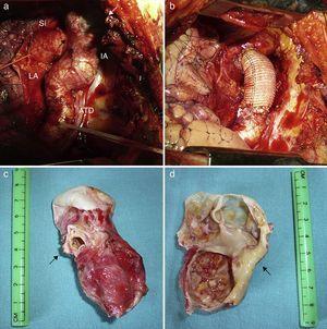 a) Visión intraoperatoria del istmo (IA) y la aorta torácica descendente (ATD), con la estenosis previa al aneurisma (flecha negra) y el aneurisma sacular (flecha blanca). b) Resultado postoperatorio tras sustitución del istmo aórtico patológico por un injerto vascular. c) Pieza quirúrgica mostrando la estenosis severa del istmo (flecha). d) Imagen interior de la pieza quirúrgica abierta mostrando el marcado adelgazamiento de la pared del aneurisma sacular (flecha). LA: ligamento arterioso; SI: arteria subclavia izquierda.