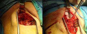 Imágenes quirúrgicas mostrando saco aneurismático antes y después de su apertura.