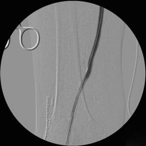 Resultado angiográfico tras dilatación y colocación del stent autoexpandible 6×40mm.
